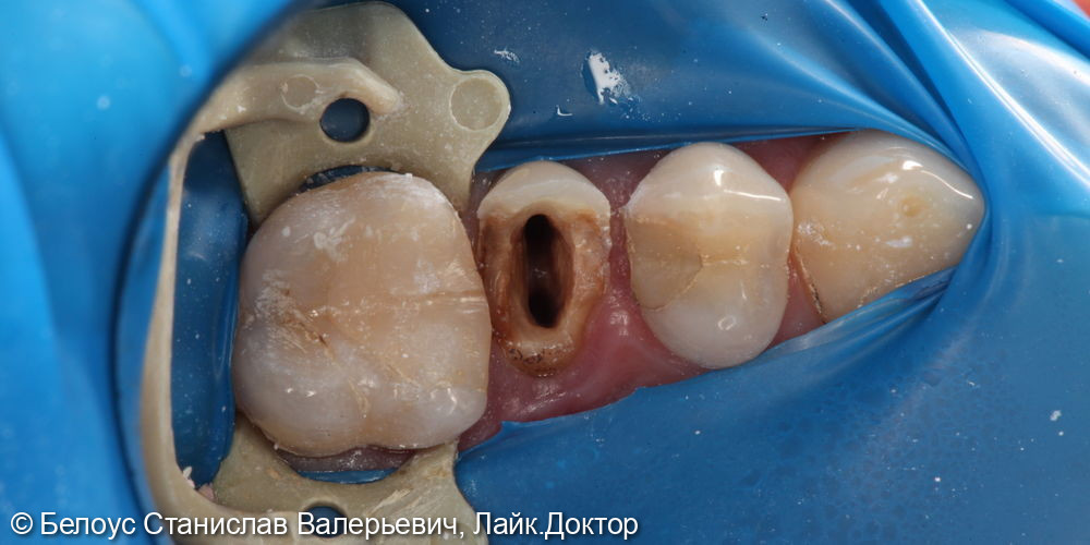 Лечение каналов и установка коронок на 2.4,2.5,2.6 зубе - фото №2