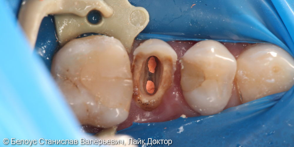 Лечение каналов и установка коронок на 2.4,2.5,2.6 зубе - фото №3
