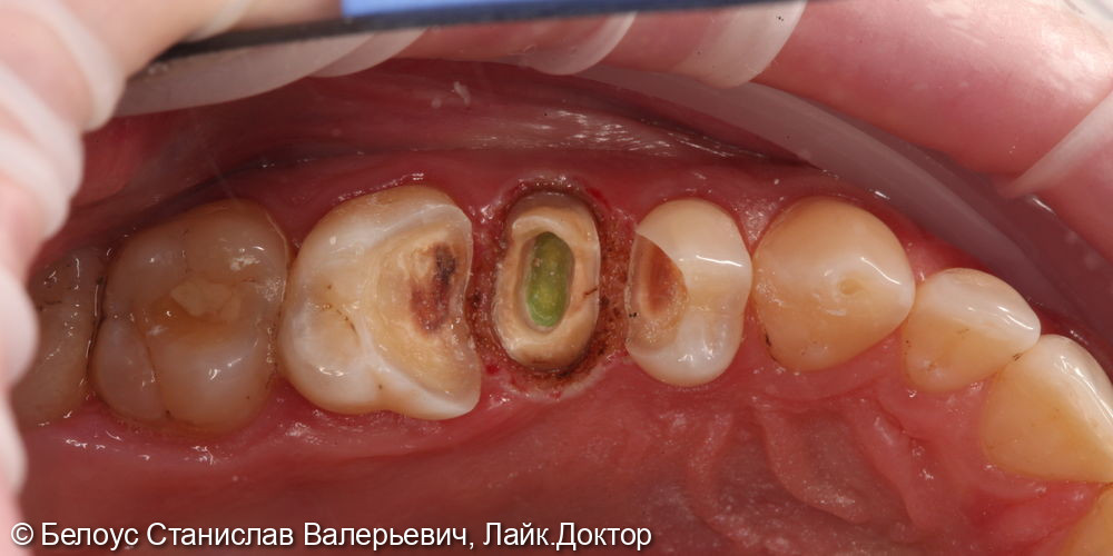 Лечение каналов и установка коронок на 2.4,2.5,2.6 зубе - фото №4