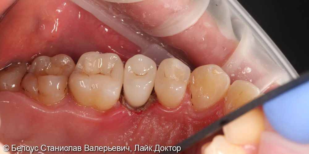 Лечение каналов и установка коронок на 2.4,2.5,2.6 зубе - фото №7