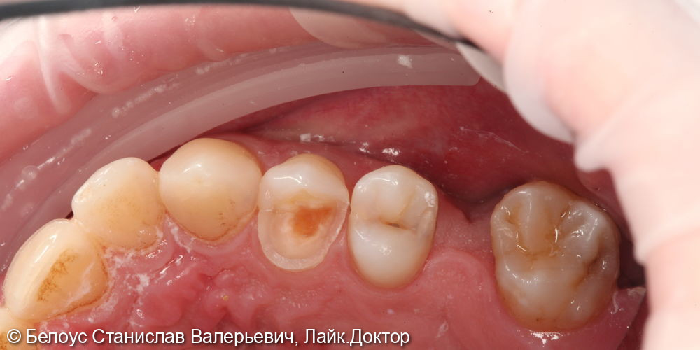 Установка керамической коронки на 1.4 зубе и лечение кариеса на 1.5 зубе - фото №1