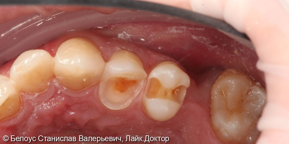 Установка керамической коронки на 1.4 зубе и лечение кариеса на 1.5 зубе - фото №2