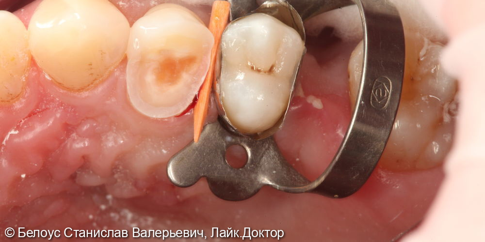 Установка керамической коронки на 1.4 зубе и лечение кариеса на 1.5 зубе - фото №3