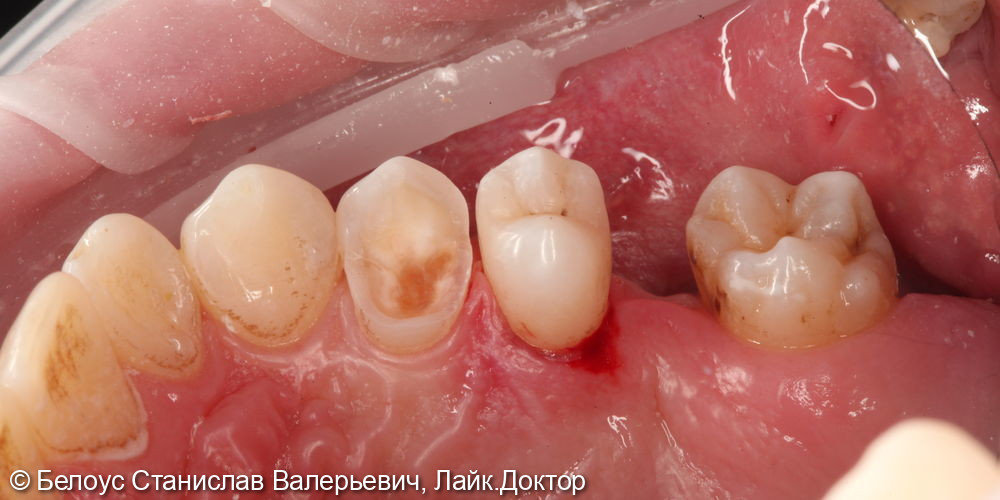 Установка керамической коронки на 1.4 зубе и лечение кариеса на 1.5 зубе - фото №4