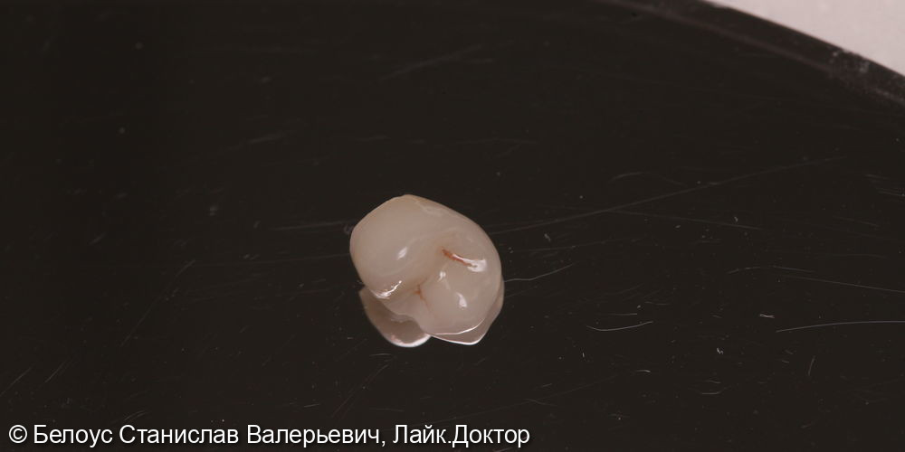 Установка керамической коронки на 1.4 зубе и лечение кариеса на 1.5 зубе - фото №5