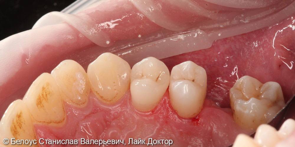 Установка керамической коронки на 1.4 зубе и лечение кариеса на 1.5 зубе - фото №6