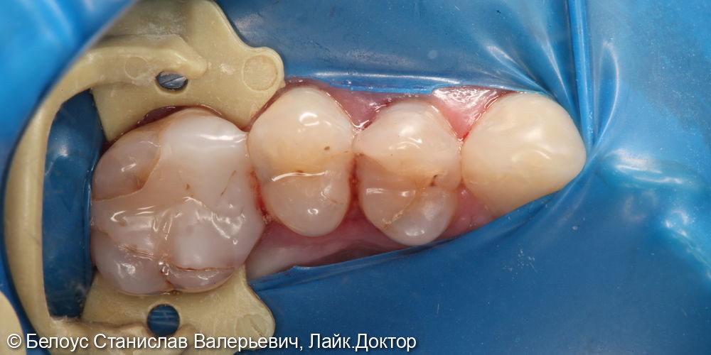 Лечение каналов 2.6 и 2.4 зубов - фото №1