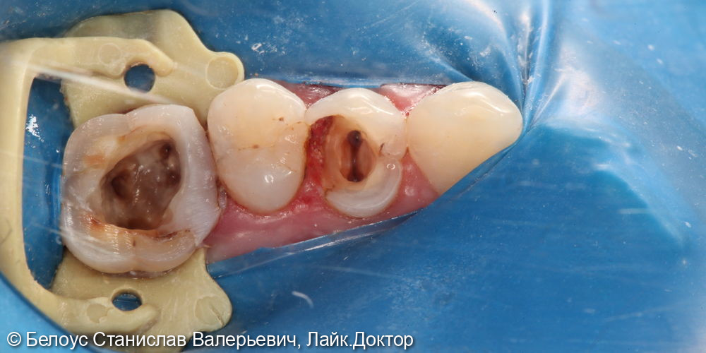 Лечение каналов 2.6 и 2.4 зубов - фото №3