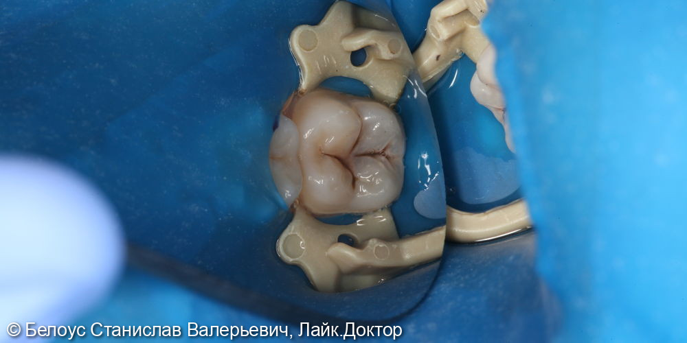 Лечение глубокого кариеса на жевательной поверхности 3.7 зуба - фото №1