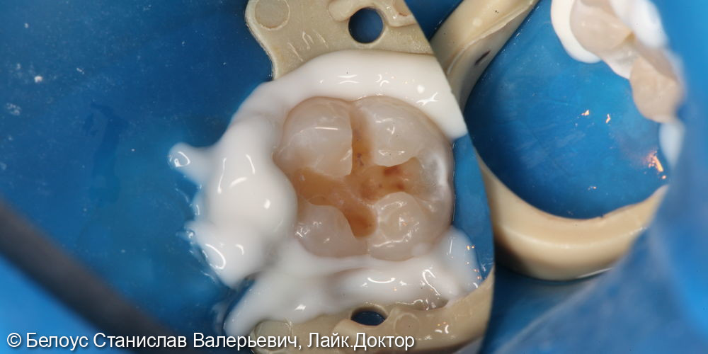 Лечение глубокого кариеса на жевательной поверхности 3.7 зуба - фото №3