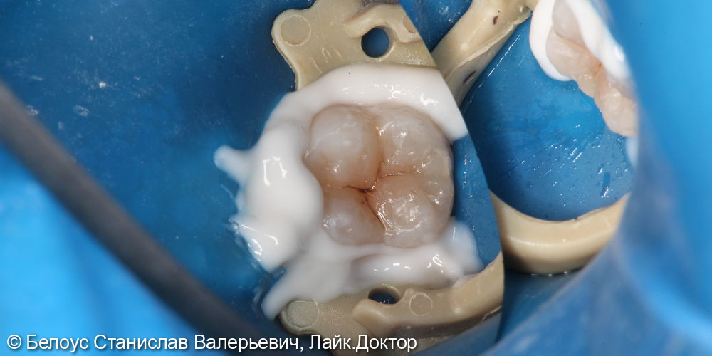 Лечение глубокого кариеса на жевательной поверхности 3.7 зуба - фото №5