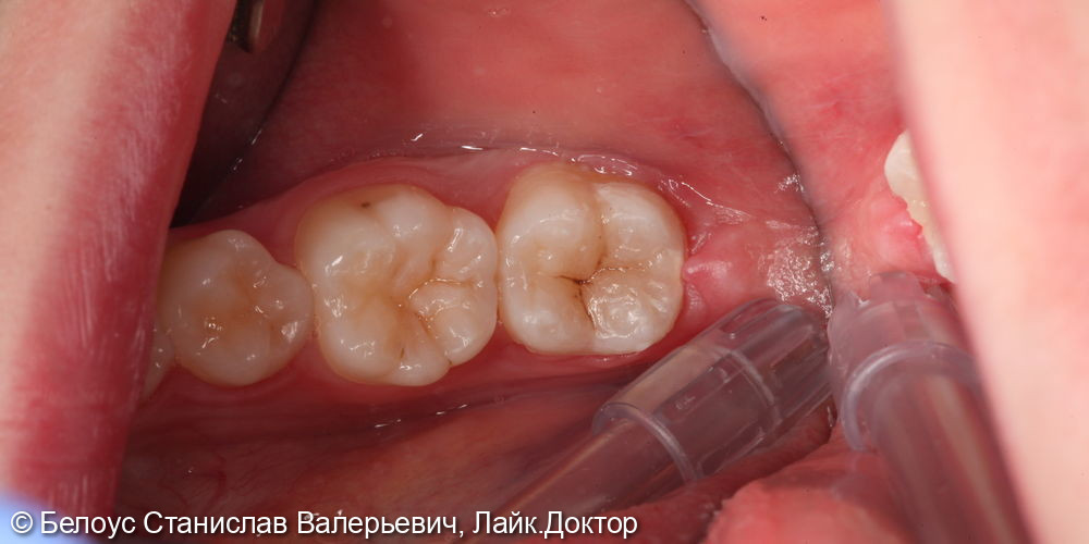 Лечение глубокого кариеса на жевательной поверхности 3.7 зуба - фото №6
