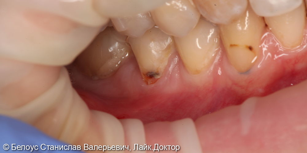 Лечение клиновидного дефекта на 4.5 зубе - фото №1