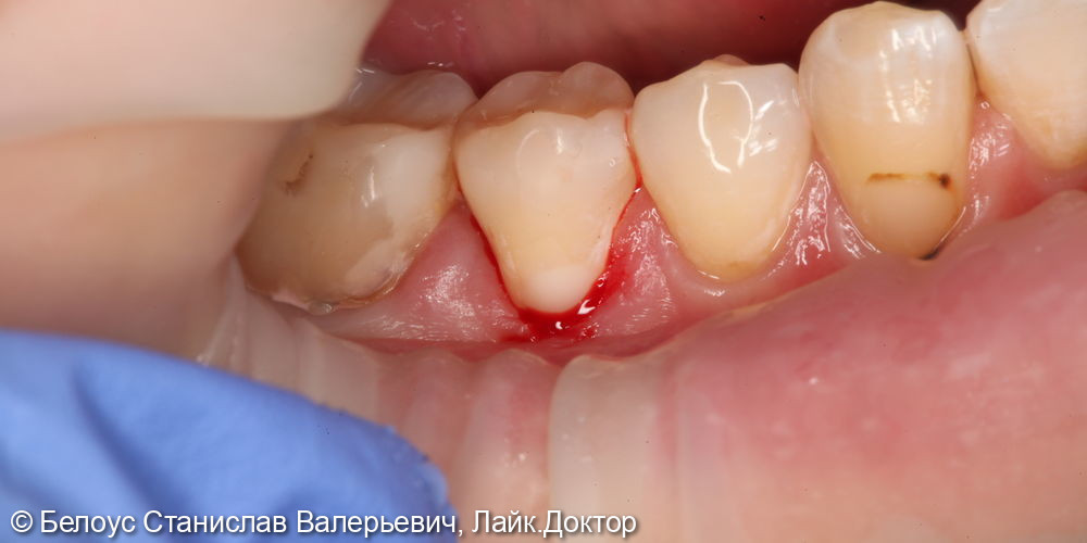 Лечение клиновидного дефекта на 4.5 зубе - фото №3