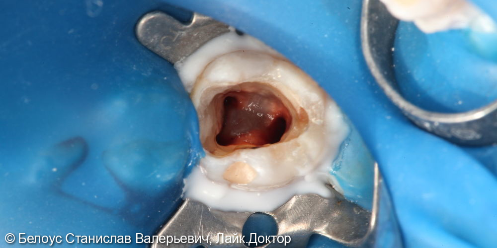 Лечение каналов в 4.6 зубе - фото №2