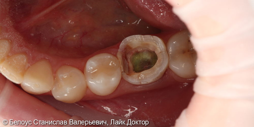 Лечение каналов в 4.6 зубе - фото №5