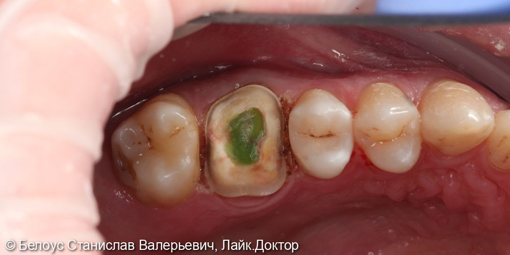 Установка керамической коронки CAD/CAM 2.6 зуба - фото №2