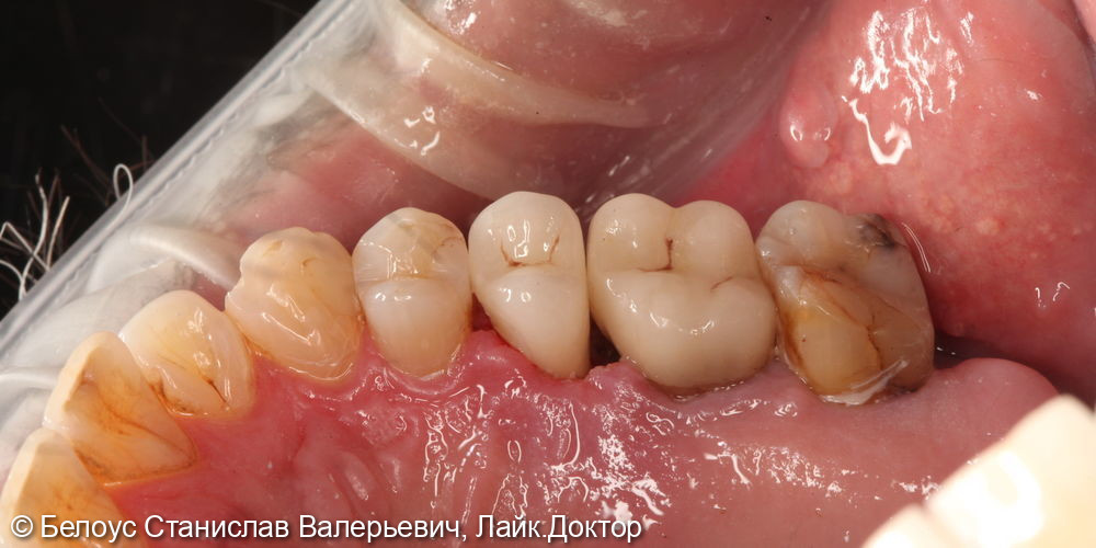 Лечение каналов и установка керамической коронки 1.5 зуба - фото №4