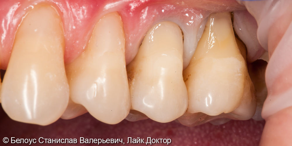 Лечение клиновидного дефекта 1.6,2.5,2.6 зубов - фото №1