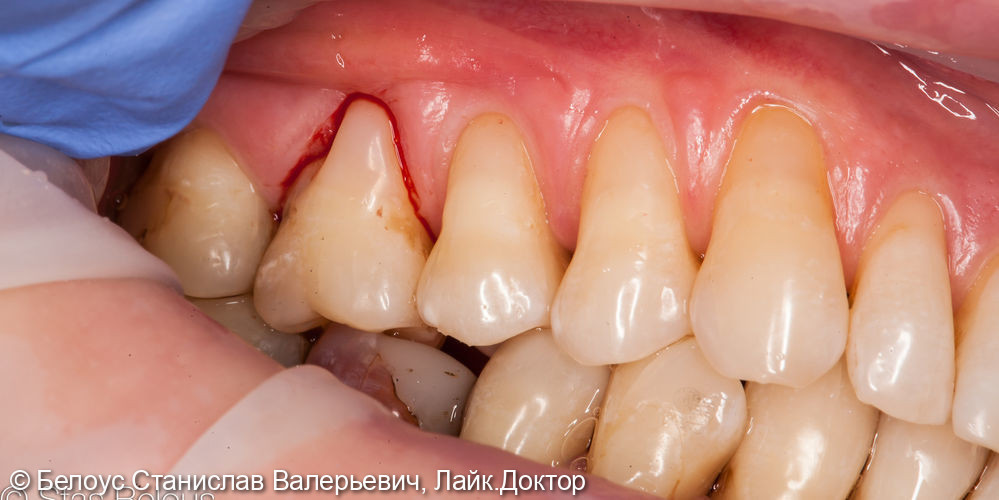 Лечение клиновидного дефекта 1.6,2.5,2.6 зубов - фото №2