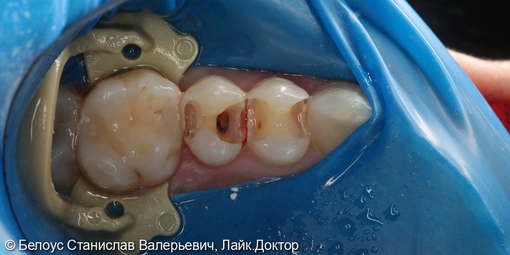 Лечение кариеса 2,4 и 2,5 зуба - фото №1