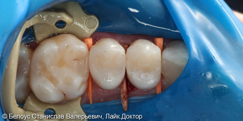 Лечение кариеса 2,4 и 2,5 зуба - фото №2