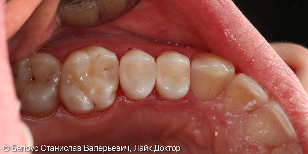 Лечение кариеса 2,4 и 2,5 зуба - фото №3