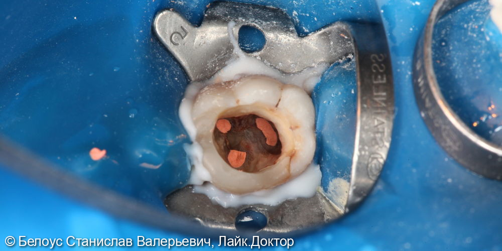 Лечение каналов и установка коронки CAD/CAM в 3.6 зубе - фото №3