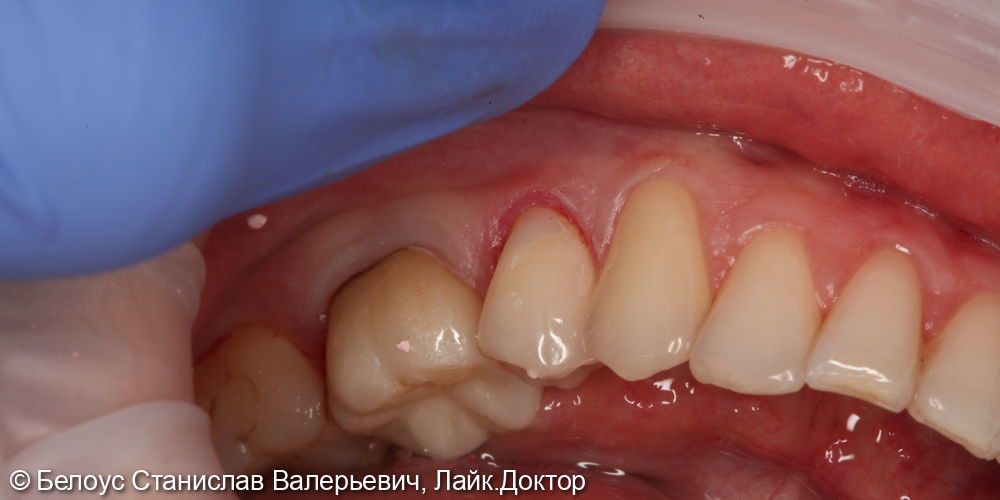 Лечение клиновидных дефектов 3.4 и 4.4 зубов - фото №2
