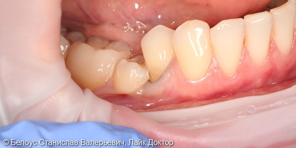 Лечение клиновидных дефектов 3.4 и 4.4 зубов - фото №1