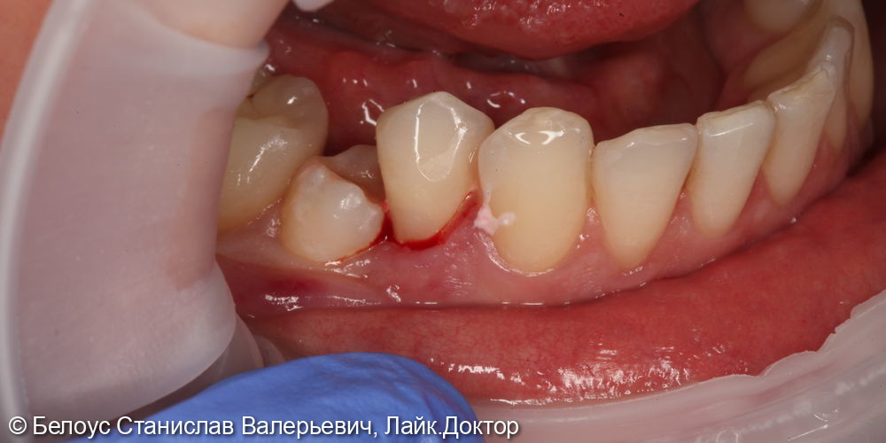 Лечение клиновидных дефектов 3.4 и 4.4 зубов - фото №4