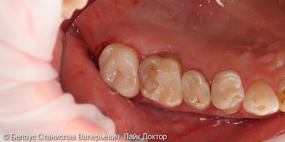 Установка керамической коронки CAD/CAM на 1.7 зубе - фото №3