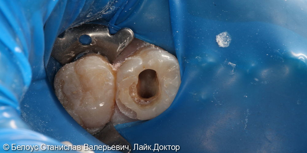 Лечение каналов и установка керамической коронки в 2.6 зубе - фото №1