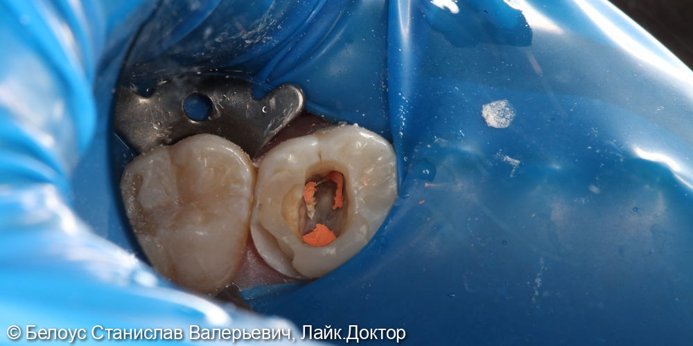 Лечение каналов и установка керамической коронки в 2.6 зубе - фото №2