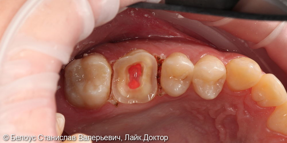 Лечение каналов и установка керамической коронки в 2.6 зубе - фото №3
