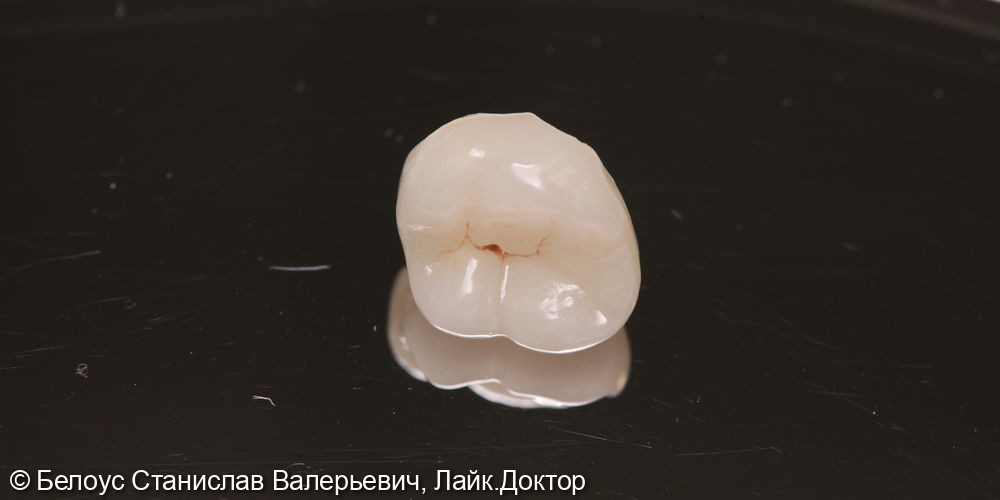 Лечение каналов и установка керамической коронки в 2.6 зубе - фото №4