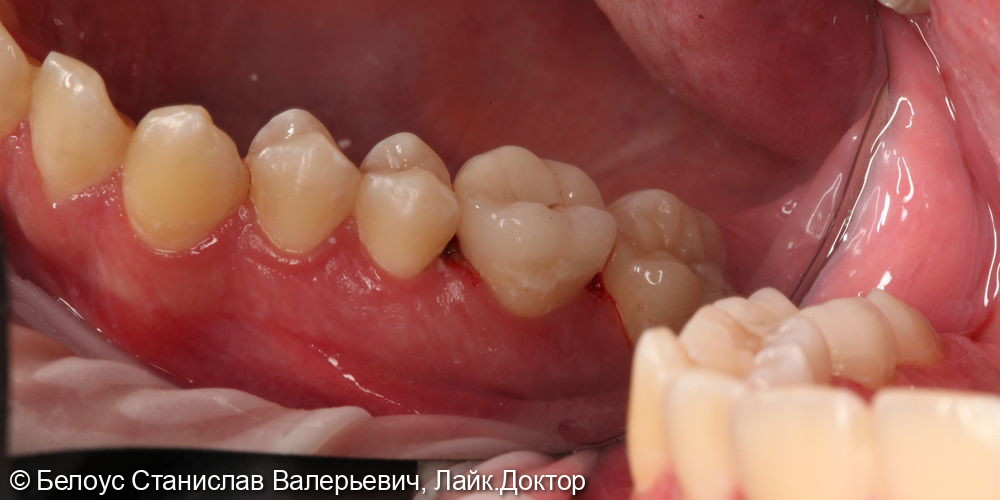 Лечение каналов и установка керамической коронки в 2.6 зубе - фото №5