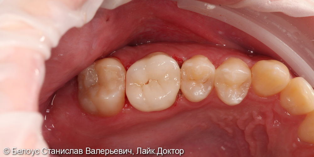 Лечение каналов и установка керамической коронки в 2.6 зубе - фото №6