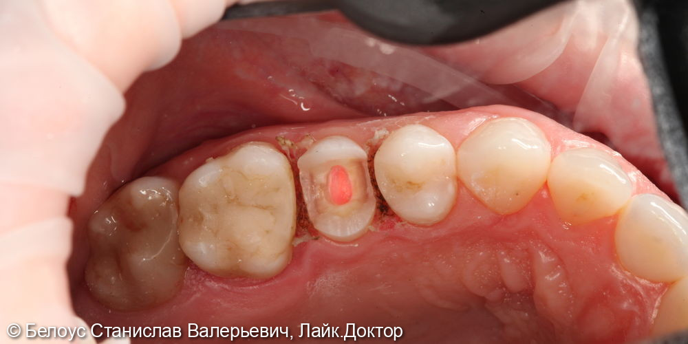 Лечение канала и установка керамической CAD/CAM коронки на 2.5 зубе - фото №1