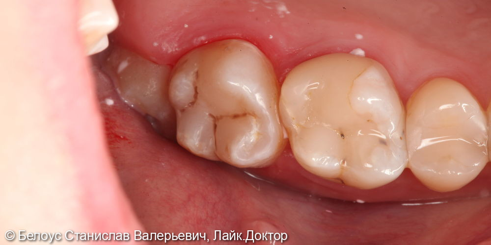 Лечение глубокого кариеса на 1.7 зубе и удаление зуба мудрости 1.8 - фото №1