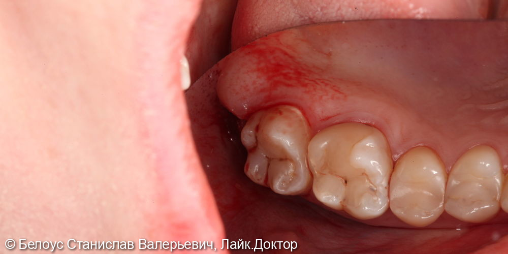 Лечение глубокого кариеса на 1.7 зубе и удаление зуба мудрости 1.8 - фото №5