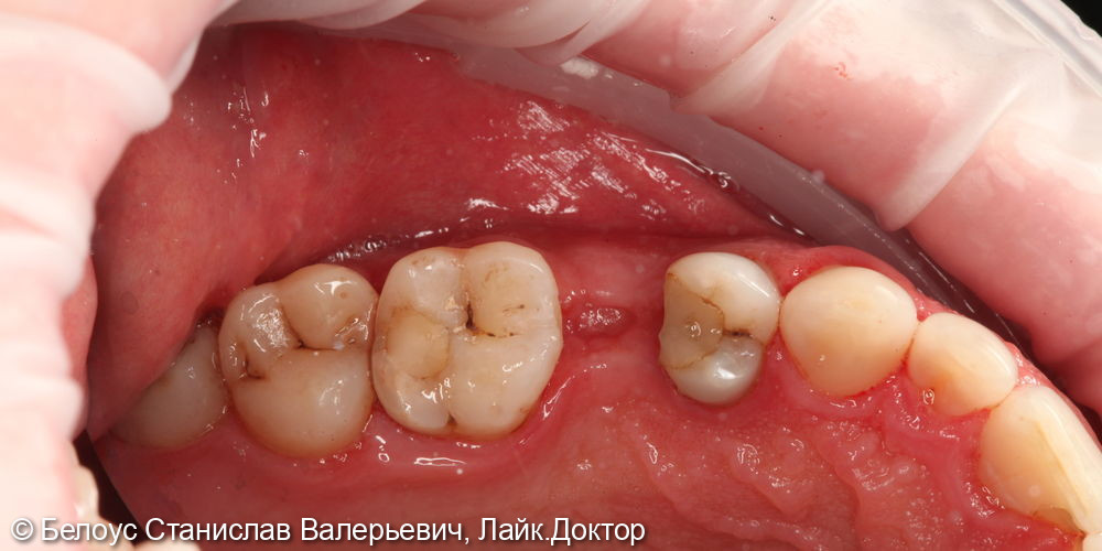 Лечение глубокого кариеса в 2.6 зубе - фото №1