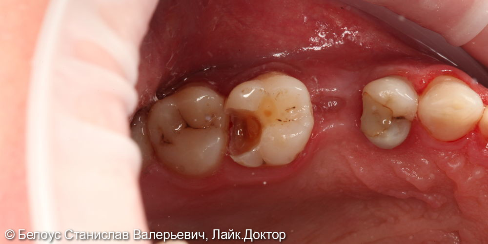 Лечение глубокого кариеса в 2.6 зубе - фото №2