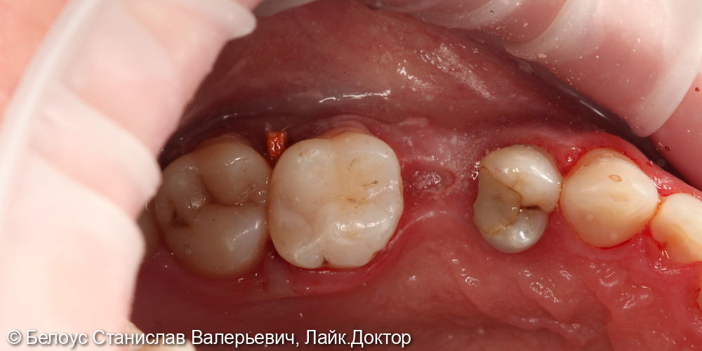 Лечение глубокого кариеса в 2.6 зубе - фото №3