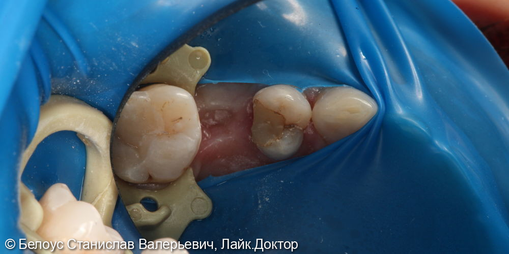 Лечение каналов в 2.4 зубе - фото №1