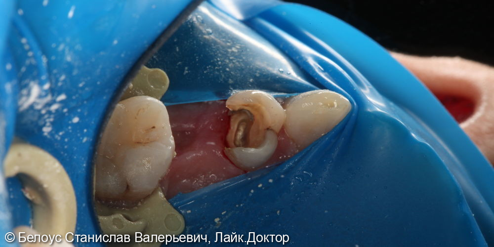 Лечение каналов в 2.4 зубе - фото №2