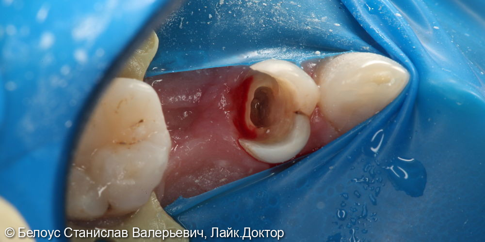 Лечение каналов в 2.4 зубе - фото №3