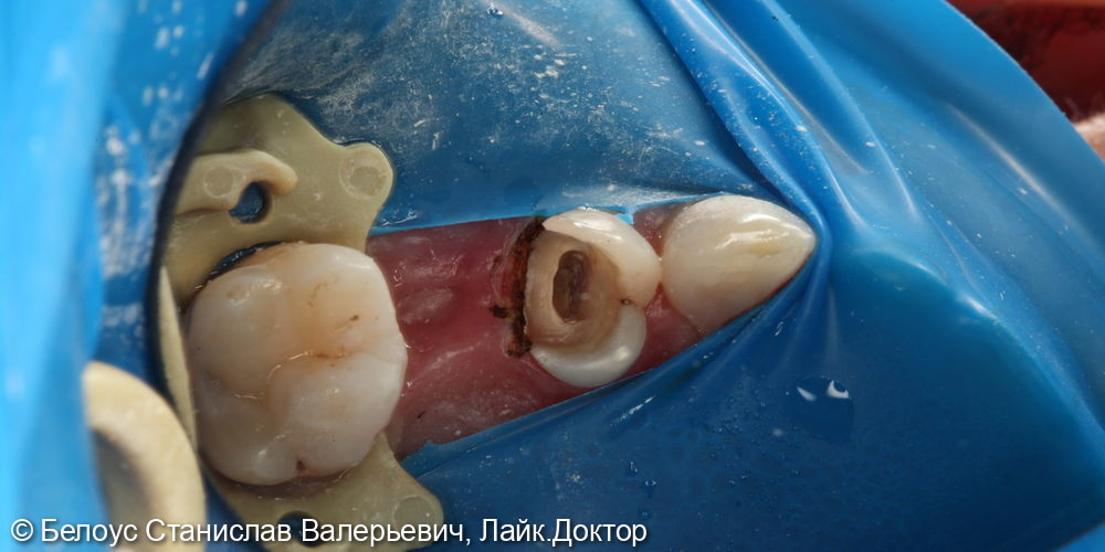 Лечение каналов в 2.4 зубе - фото №4