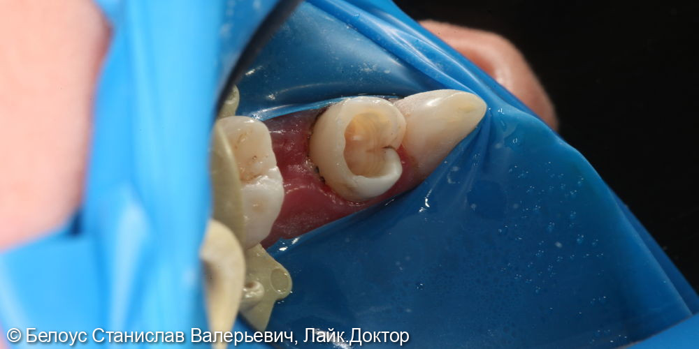Лечение каналов в 2.4 зубе - фото №6