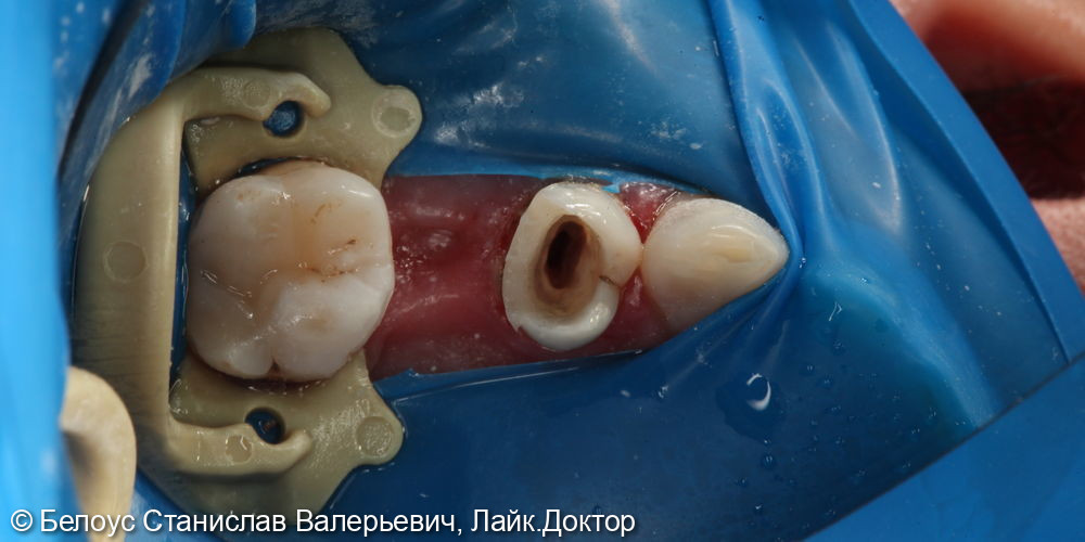 Лечение каналов в 2.4 зубе - фото №7